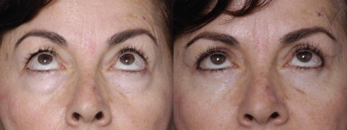 Before & After Combined Upper & Lower Eyelid Surgery Case 291 Upward Look View in Los Angeles, CA