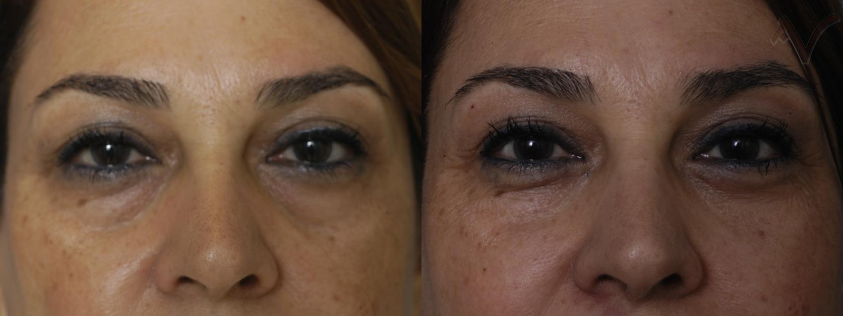 Before & After Eyelid Surgery Case 300 Front View in Los Angeles, CA