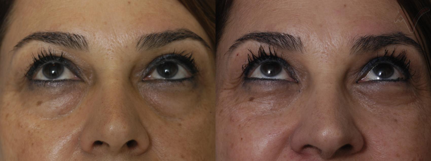 Before & After Eyelid Surgery Case 300 Upward Look View in Burbank, CA