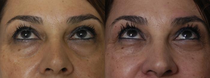 Before & After Eyelid Surgery Case 300 Upward Look View in Los Angeles, CA