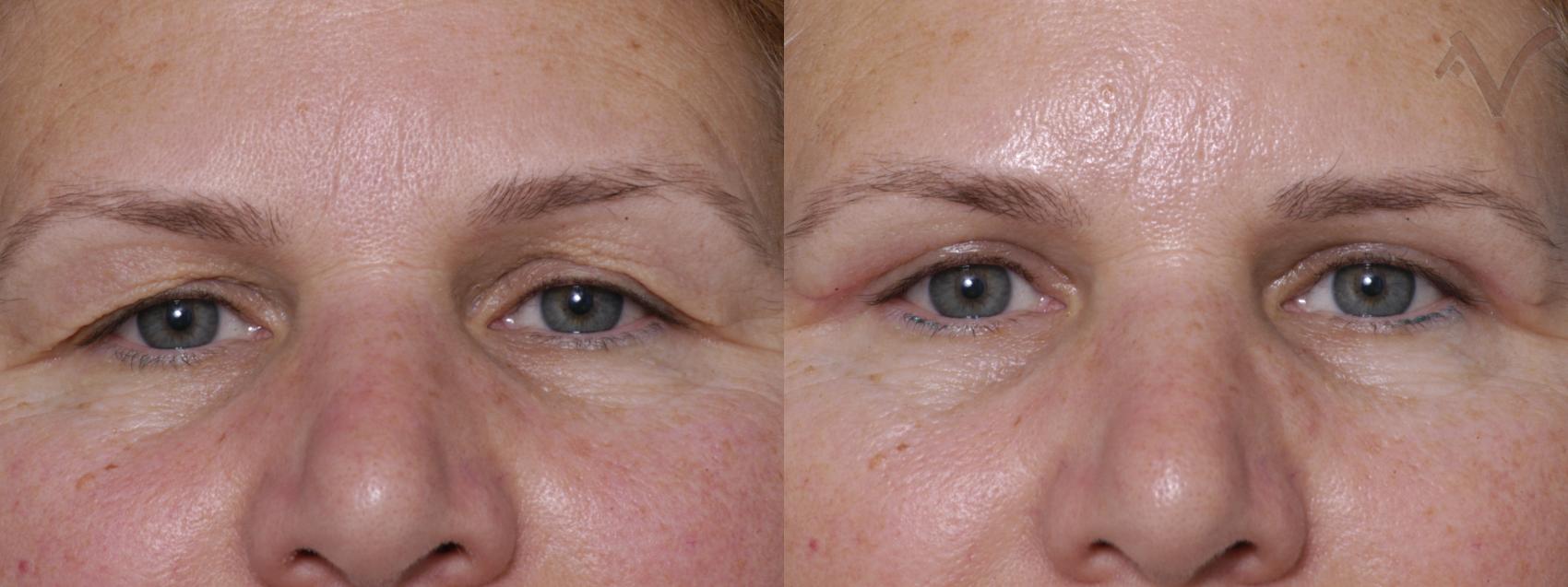 Before & After Eyelid Surgery Case 306 Front View in Burbank, CA