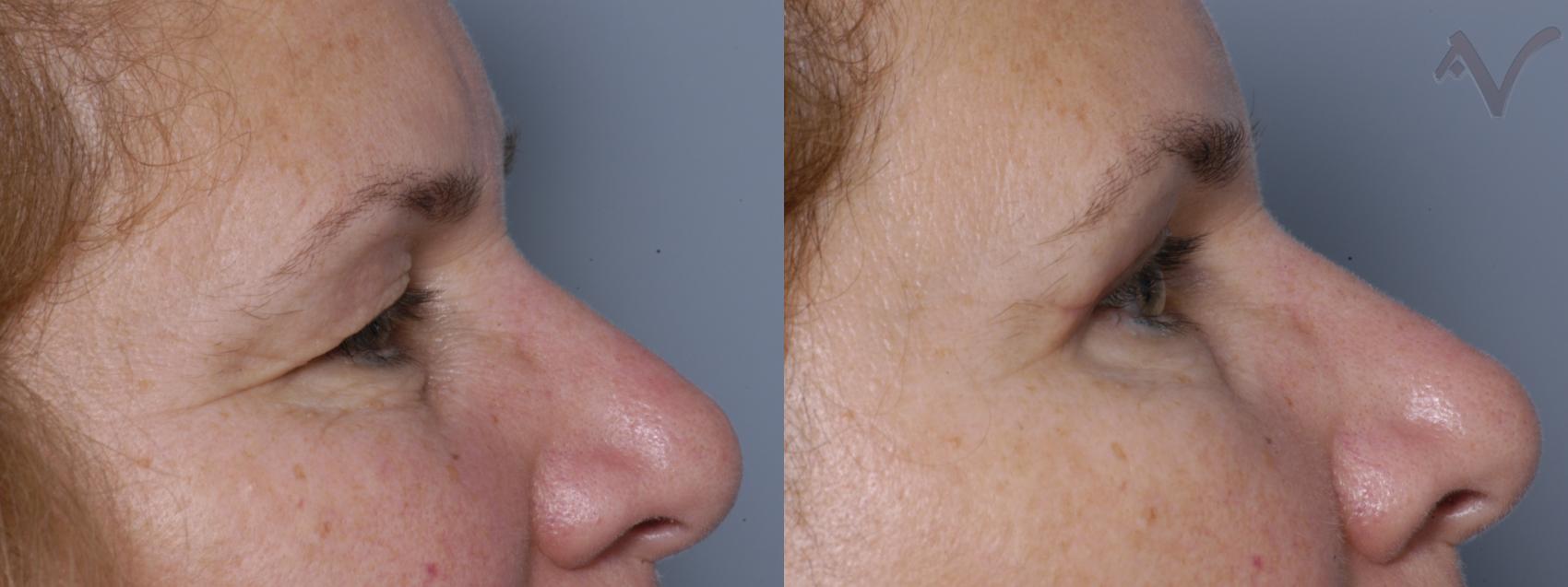 Before & After Eyelid Surgery Case 306 Right Side View in Burbank, CA
