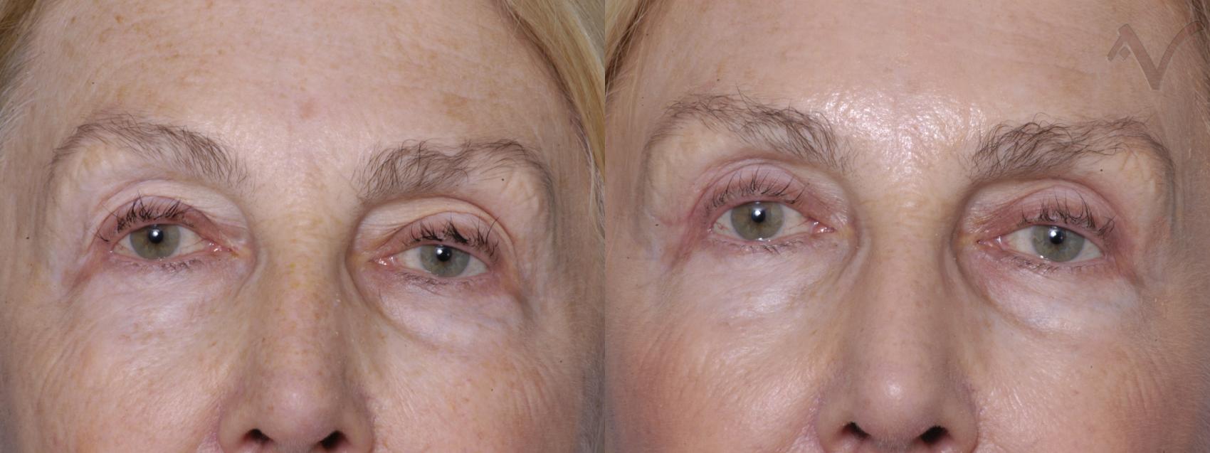 Before & After Eyelid Surgery Case 313 Front View in Burbank, CA
