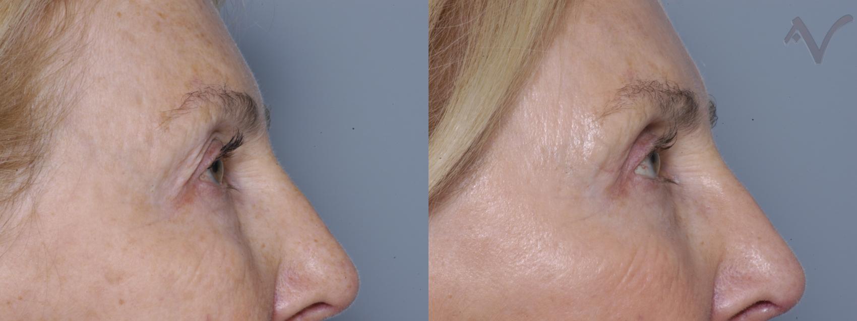 Before & After Eyelid Surgery Case 313 Right Side View in Burbank, CA