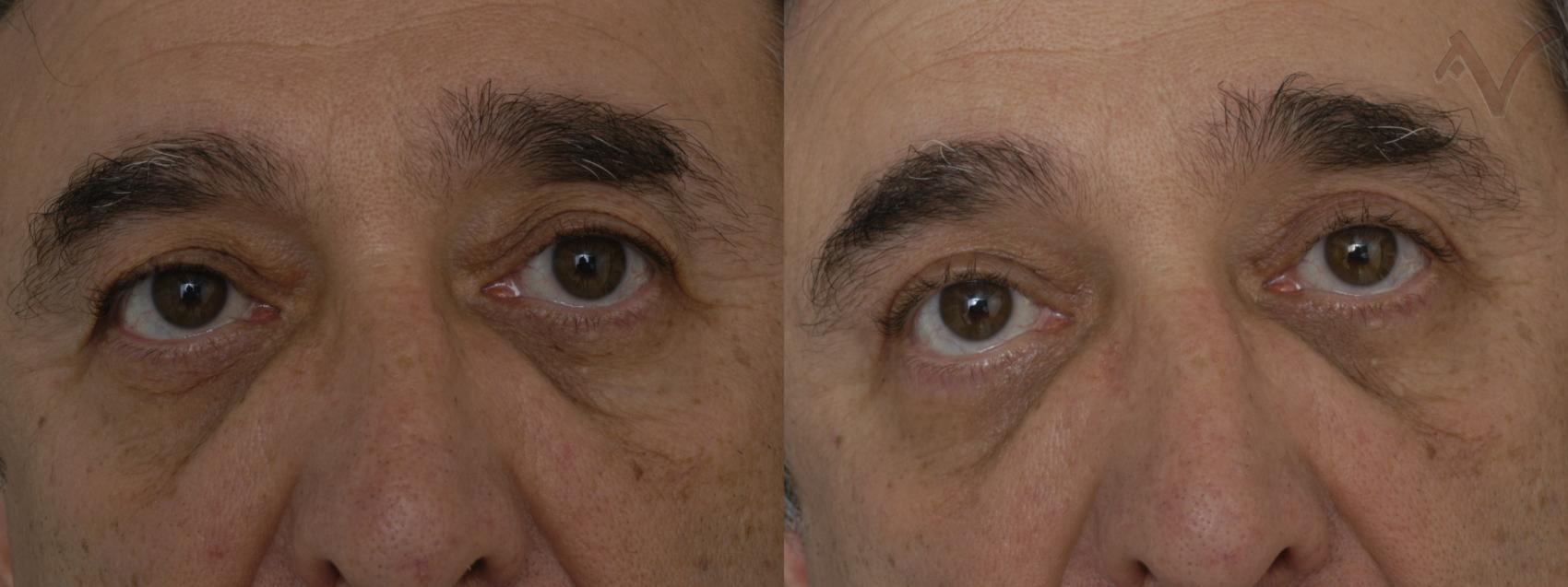 Before & After Eyelid Surgery Case 317 Front View in Los Angeles, CA