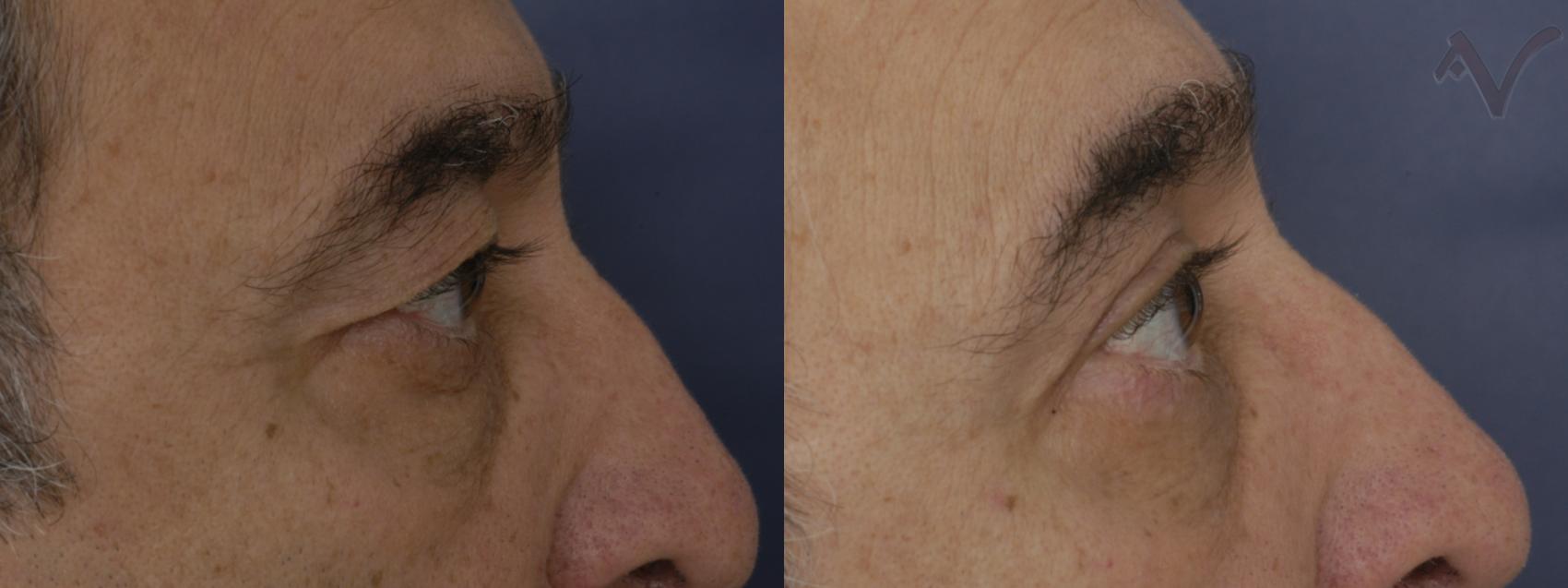Before & After Eyelid Surgery Case 317 Right Side View in Burbank, CA