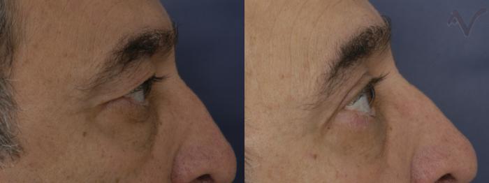 Before & After Eyelid Surgery Case 317 Right Side View in Los Angeles, CA