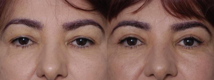 Before & After Eyelid Surgery Case 318 Front View in Los Angeles, CA