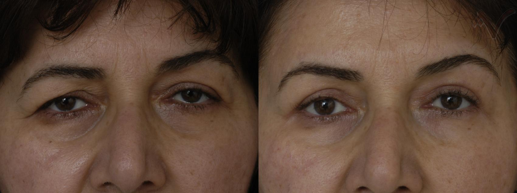 Before & After Eyelid Surgery Case 319 Front View in Burbank, CA