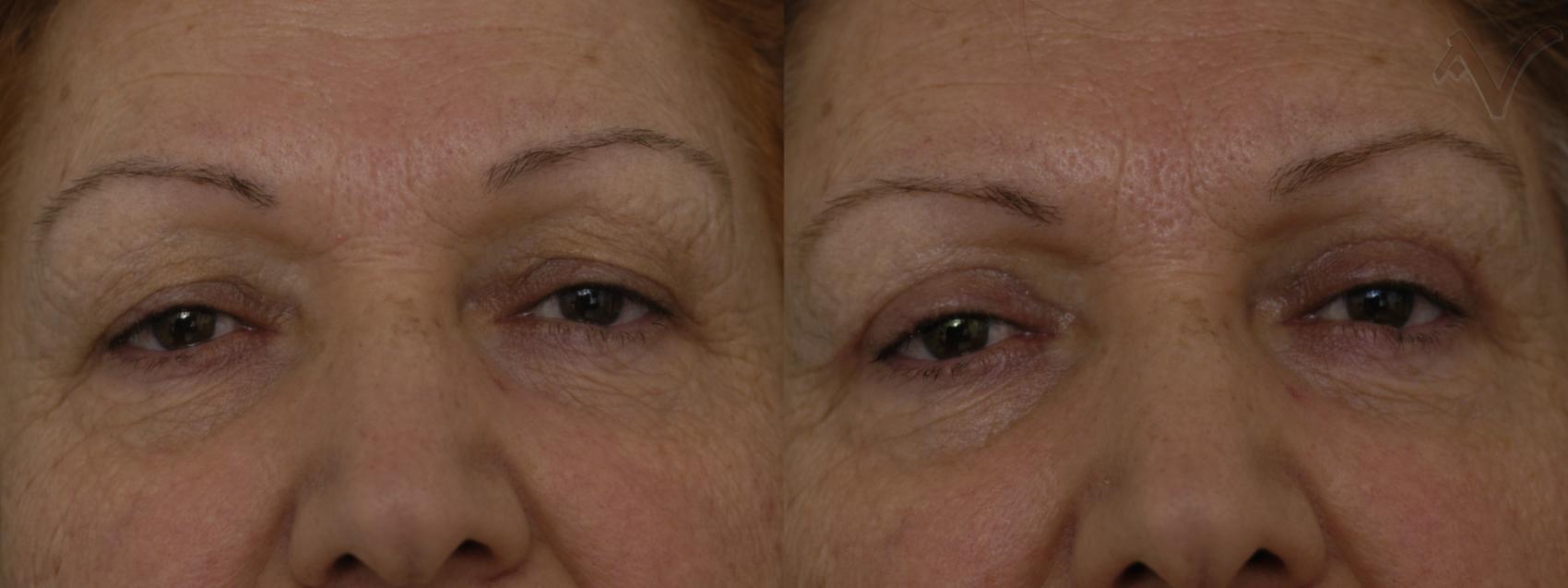 Before & After Eyelid Surgery Case 320 Front View in Burbank, CA