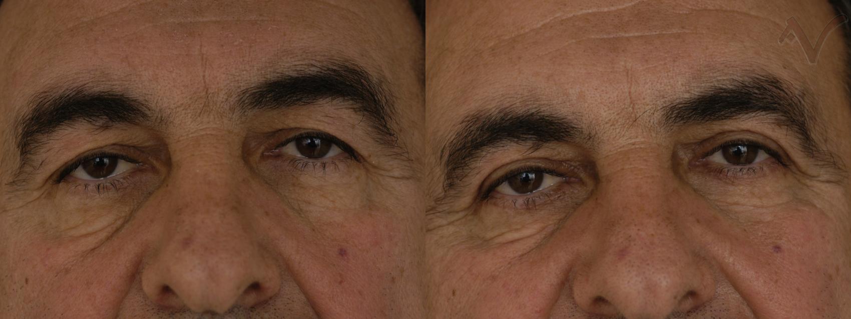 Before & After Eyelid Surgery Case 321 Front View in Burbank, CA