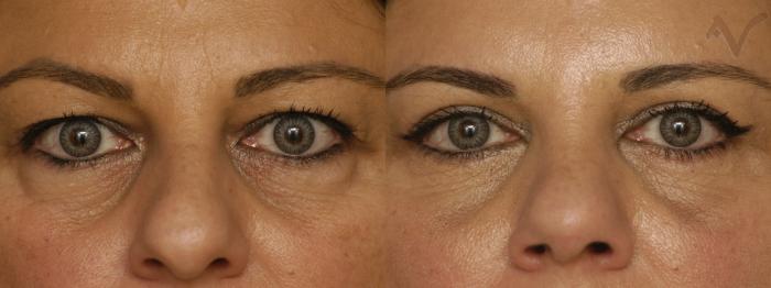 Before & After Combined Upper & Lower Eyelid Surgery Case 341 Front View in Los Angeles, CA