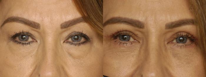 Before & After Combined Upper & Lower Eyelid Surgery Case 342 Front View in Los Angeles, CA
