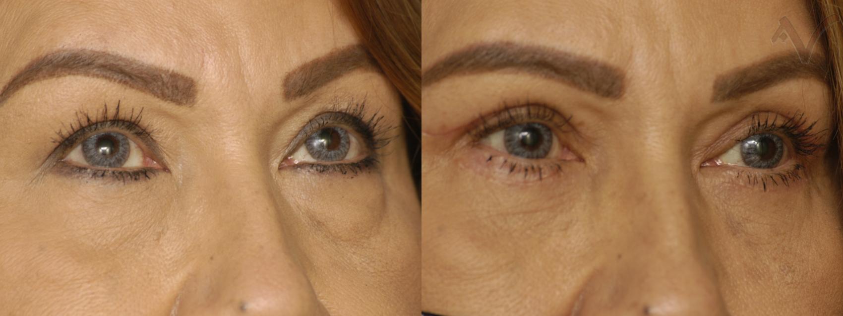Combined Upper & Lower Eyelid Surgery Before and After Pictures Case