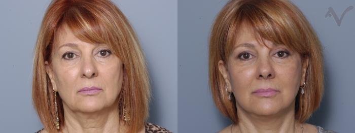 Before & After Facelift Case 167 Front View in Los Angeles, CA