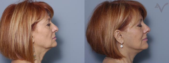 Before & After Facelift Case 167 Right Side View in Los Angeles, CA