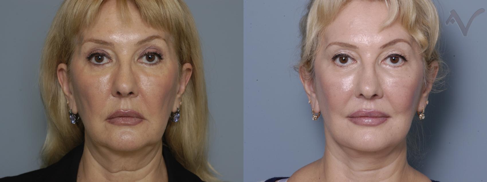Before & After Facelift Case 170 Front View in Burbank, CA