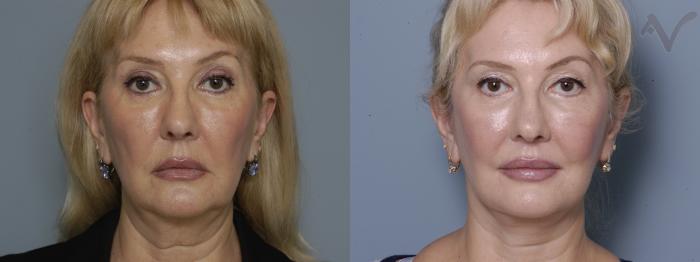 Before & After Facelift Case 170 Front View in Los Angeles, CA