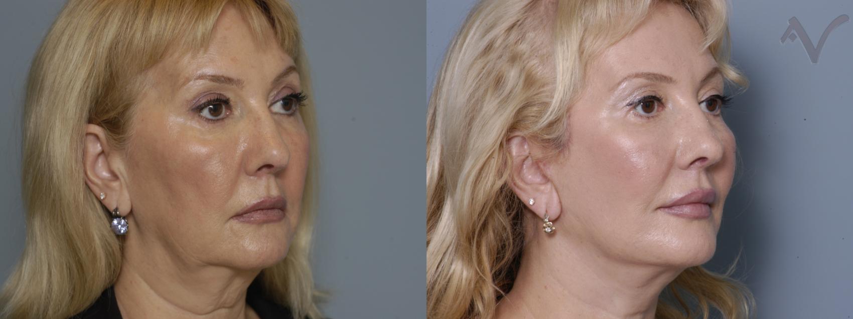 Before & After Facelift Case 170 Right Oblique View in Burbank, CA