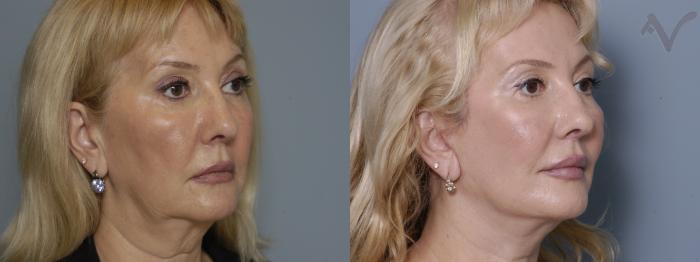 Before & After Facelift Case 170 Right Oblique View in Los Angeles, CA