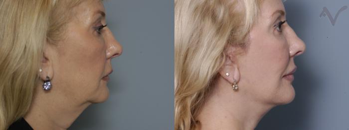 Before & After Facelift Case 170 Right Side View in Los Angeles, CA