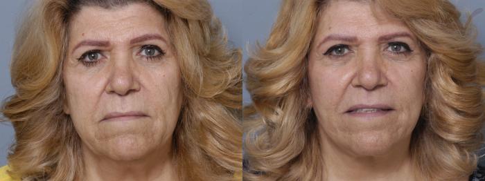 Before & After Facelift Case 176 Front View in Los Angeles, CA