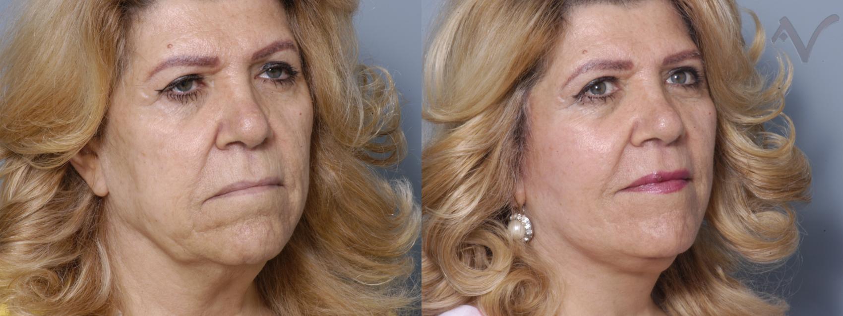 Before & After Facelift Case 176 Right Oblique View in Burbank, CA