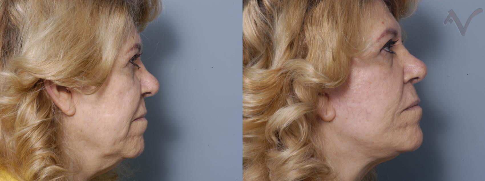Before & After Facelift Case 176 Right Side View in Los Angeles, CA