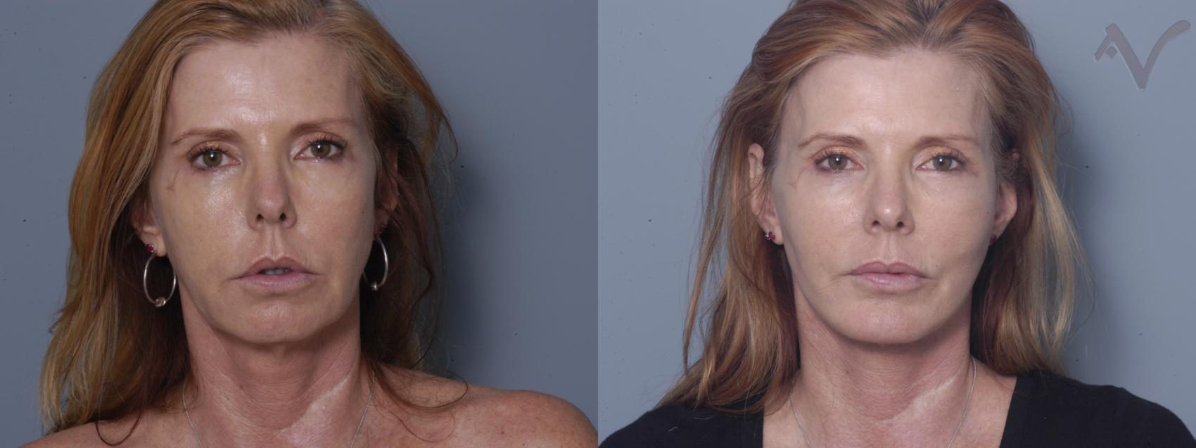 Before & After Facelift Case 187 Front View in Los Angeles, CA