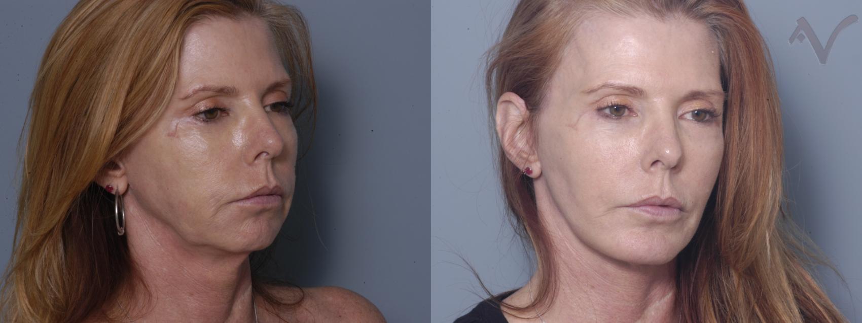 Before & After Facelift Case 187 Right Oblique View in Los Angeles, CA