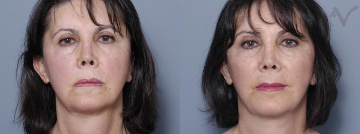 Before & After Facelift Case 198 Front View in Los Angeles, CA