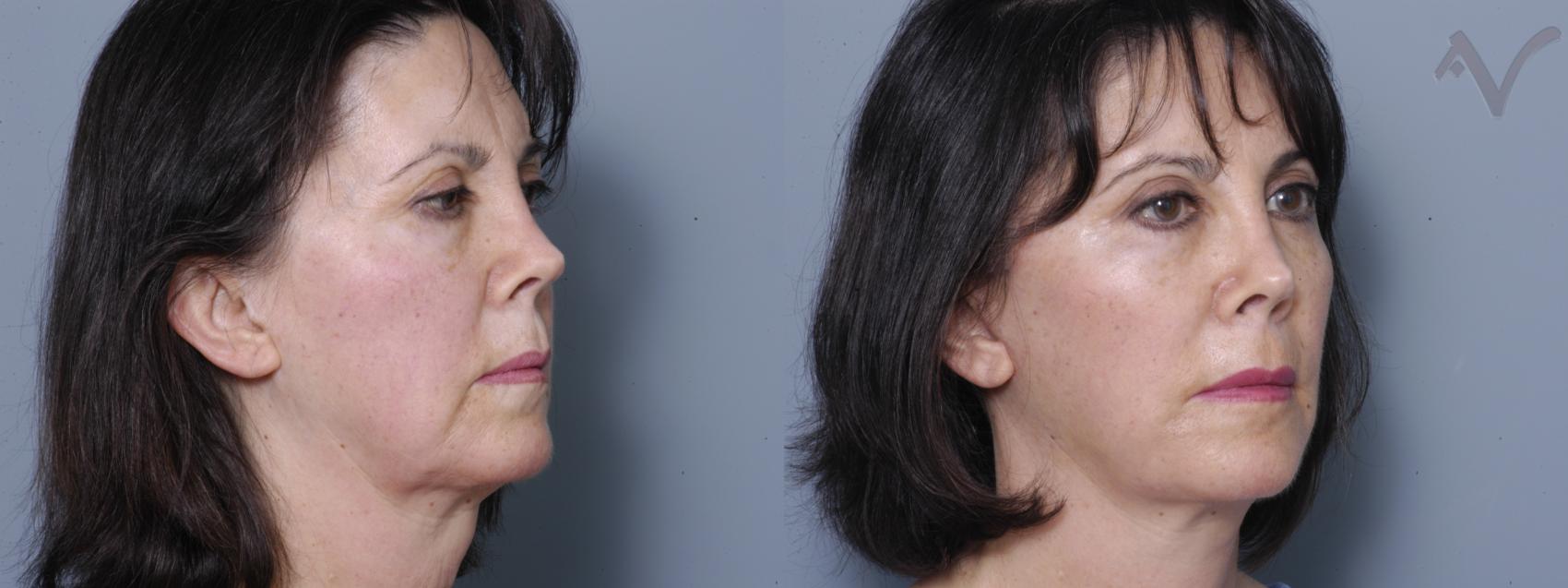 Before & After Facelift Case 198 Right Oblique View in Burbank, CA