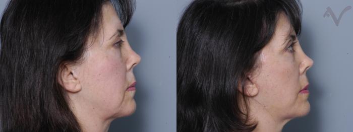 Before & After Facelift Case 198 Right Side View in Los Angeles, CA