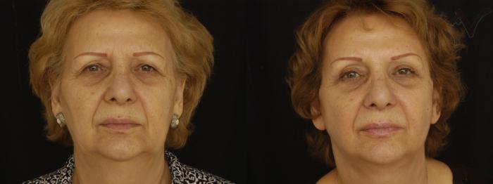 Before & After Facelift Case 200 Front View in Los Angeles, CA