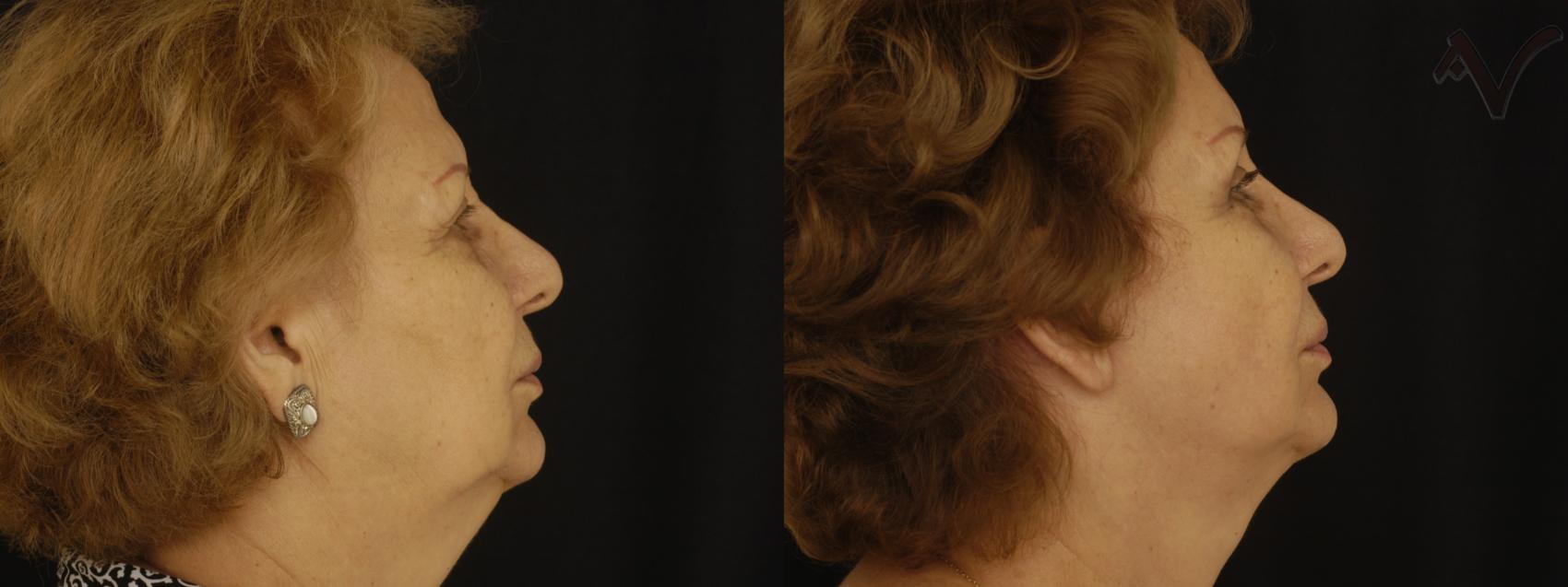 Before & After Facelift Case 200 Right Side View in Burbank, CA