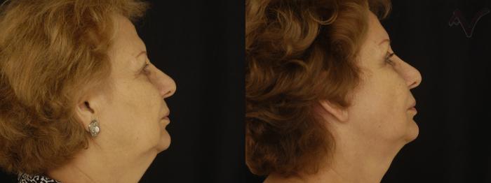 Before & After Facelift Case 200 Right Side View in Los Angeles, CA