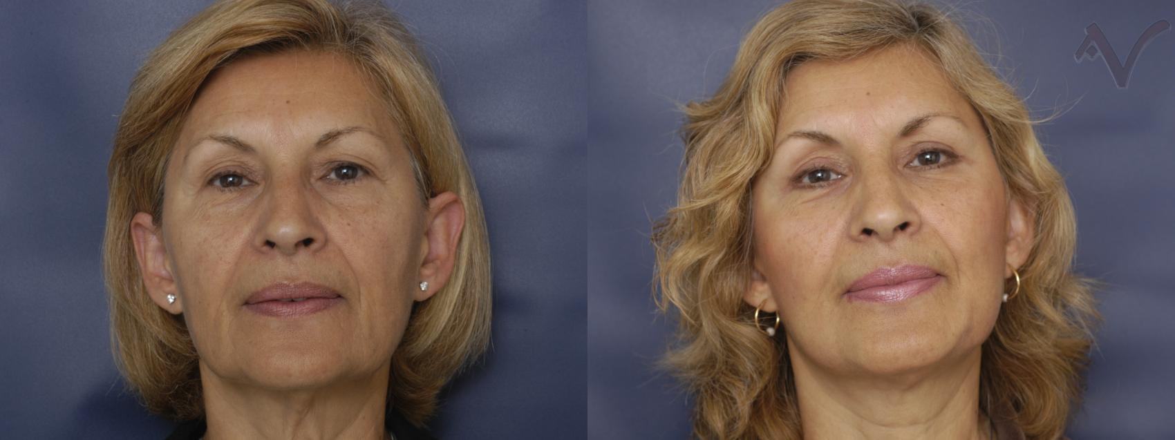 Before & After Facelift Case 204 Front View in Burbank, CA