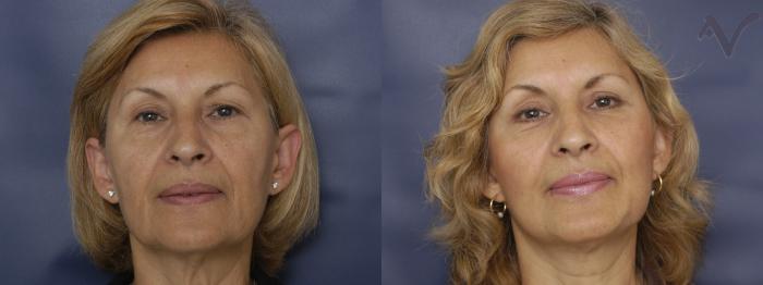Before & After Facelift Case 204 Front View in Los Angeles, CA
