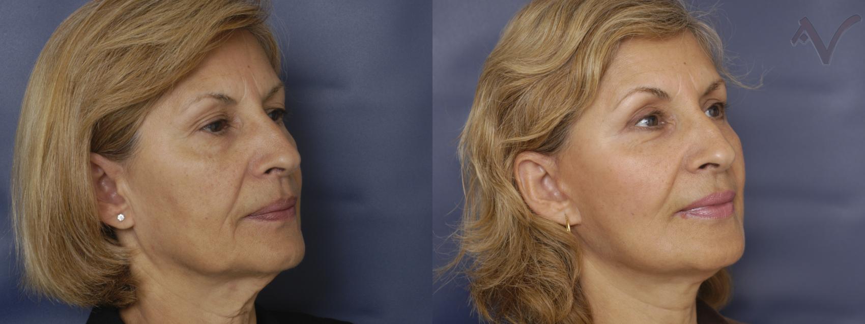 Before & After Facelift Case 204 Right Oblique View in Los Angeles, CA