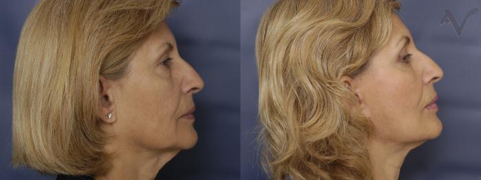 Before & After Facelift Case 204 Right Side View in Los Angeles, CA