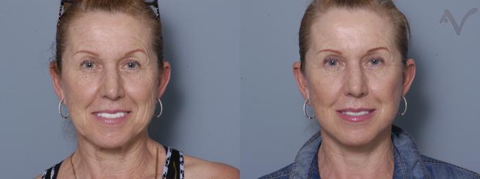 Before & After Facelift Case 209 Front View in Los Angeles, CA