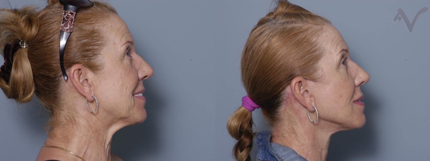 Before & After Facelift Case 209 Right Side View in Los Angeles, CA