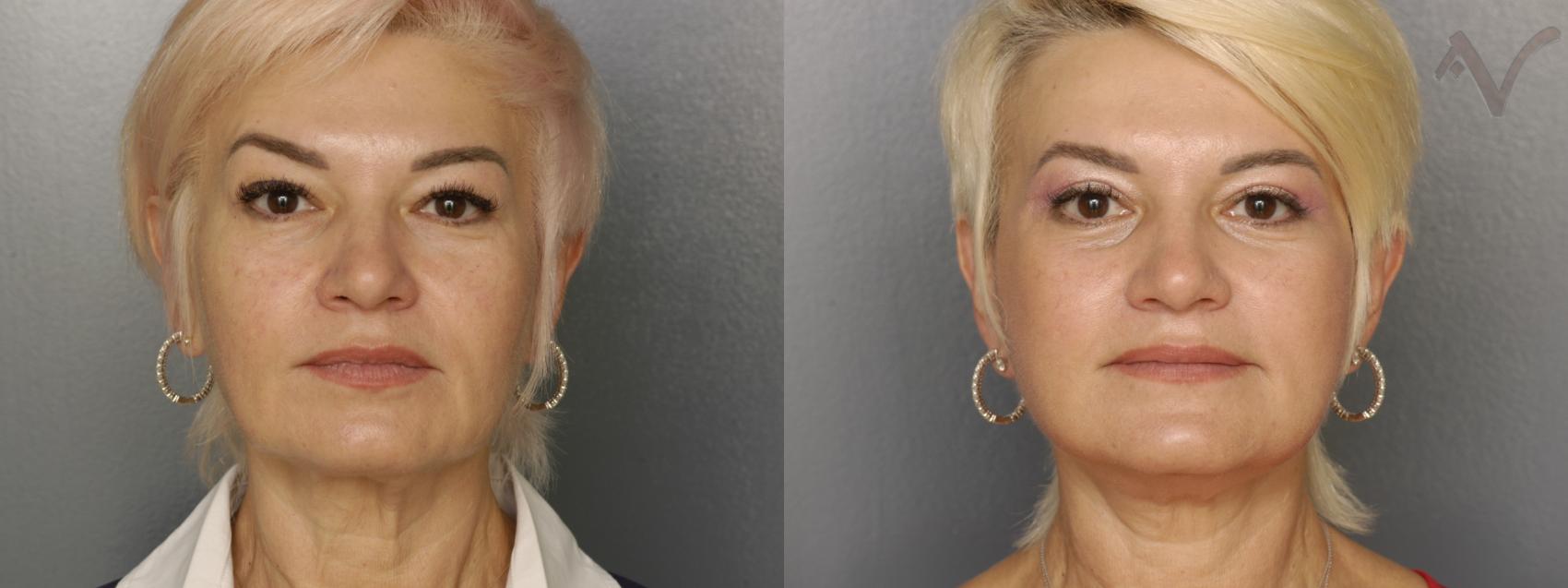 Before & After Facelift Case 221 Front View in Los Angeles, CA