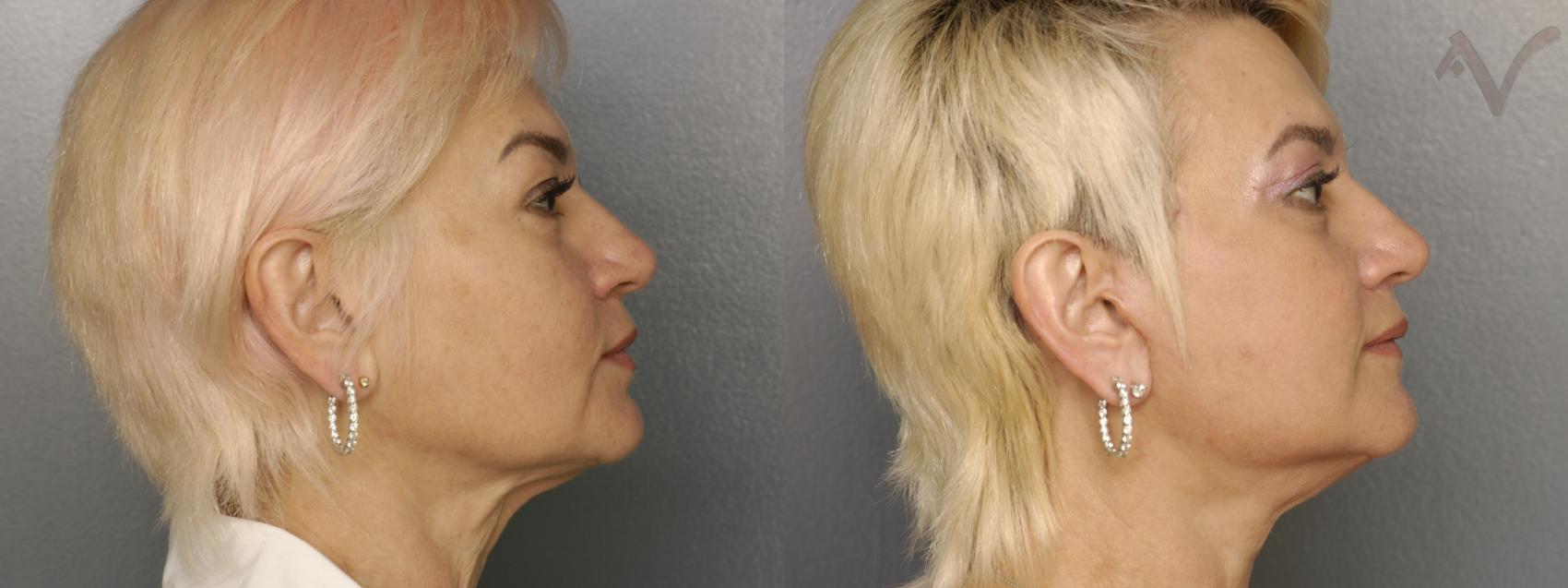 Before & After Facelift Case 221 Right Side View in Burbank, CA