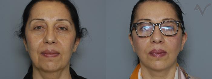 Before & After Facelift Case 225 Front View in Los Angeles, CA