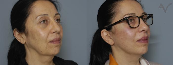 Before & After Facelift Case 225 Right Oblique View in Los Angeles, CA