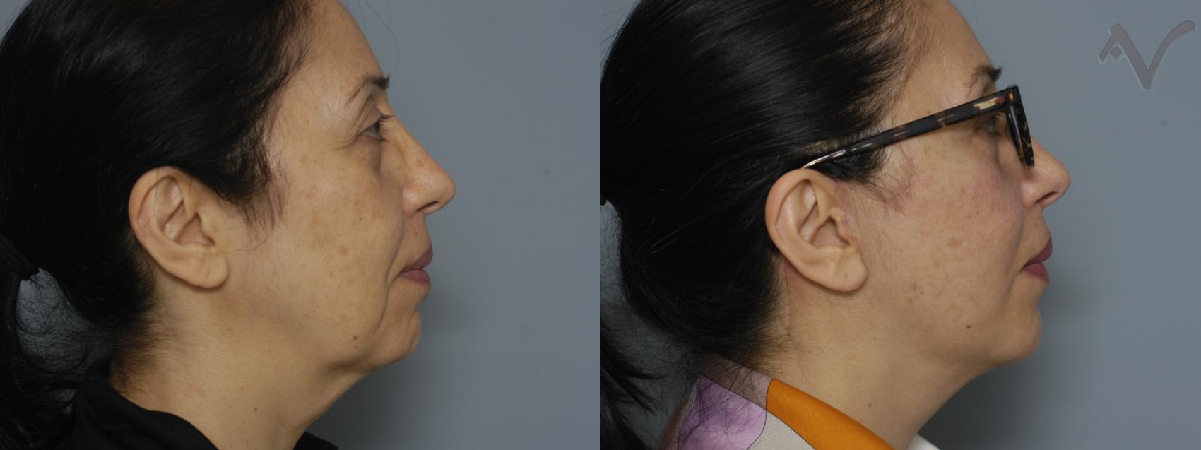 Before & After Facelift Case 225 Right Side View in Burbank, CA