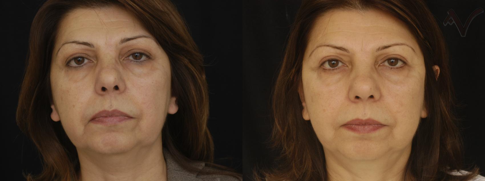 Before & After Facelift Case 227 Front View in Los Angeles, CA