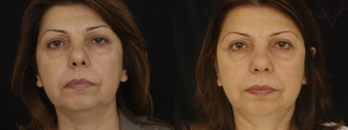 Before & After Facelift Case 227 Front View in Los Angeles, CA