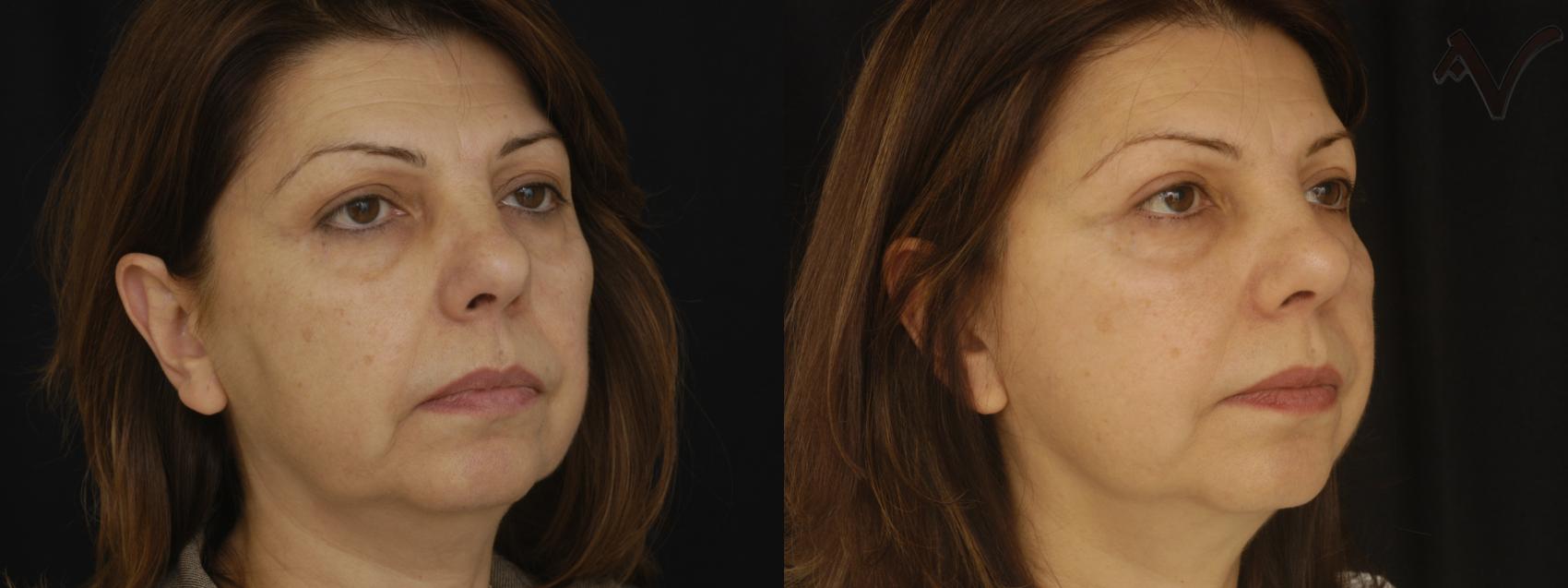 Before & After Facelift Case 227 Right Oblique View in Burbank, CA